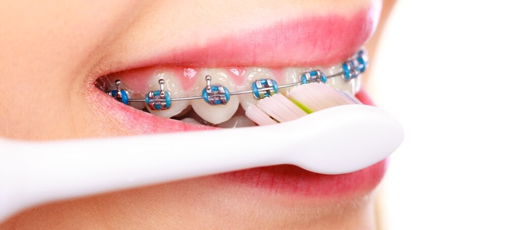 The definitive guide to brushing with braces