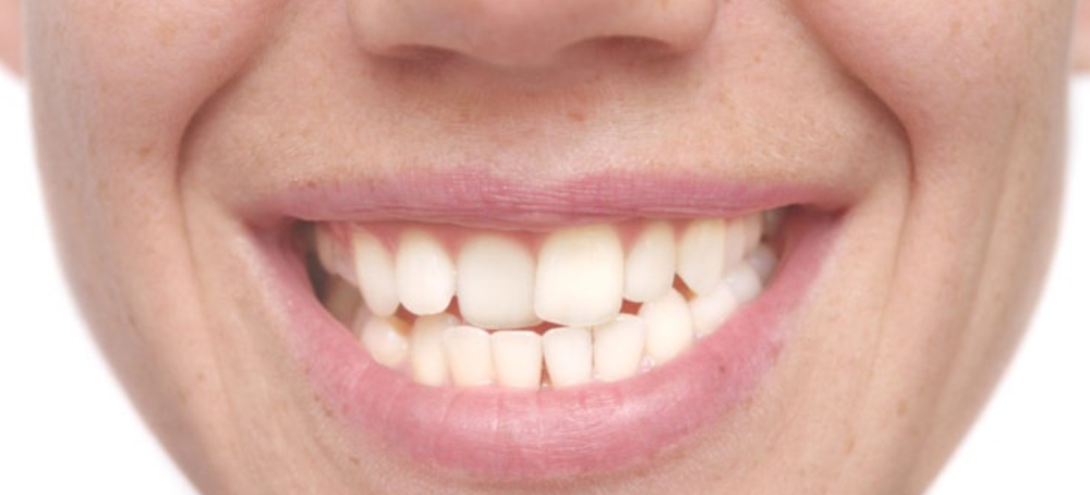 Why do teeth get crooked with age?